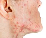 طرق علاج حب الشباب: إجراءات طبية قد تساعدك